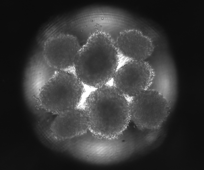 Colorectal tumoroids observed for the ALATYR and Gustave Roussy collaboration